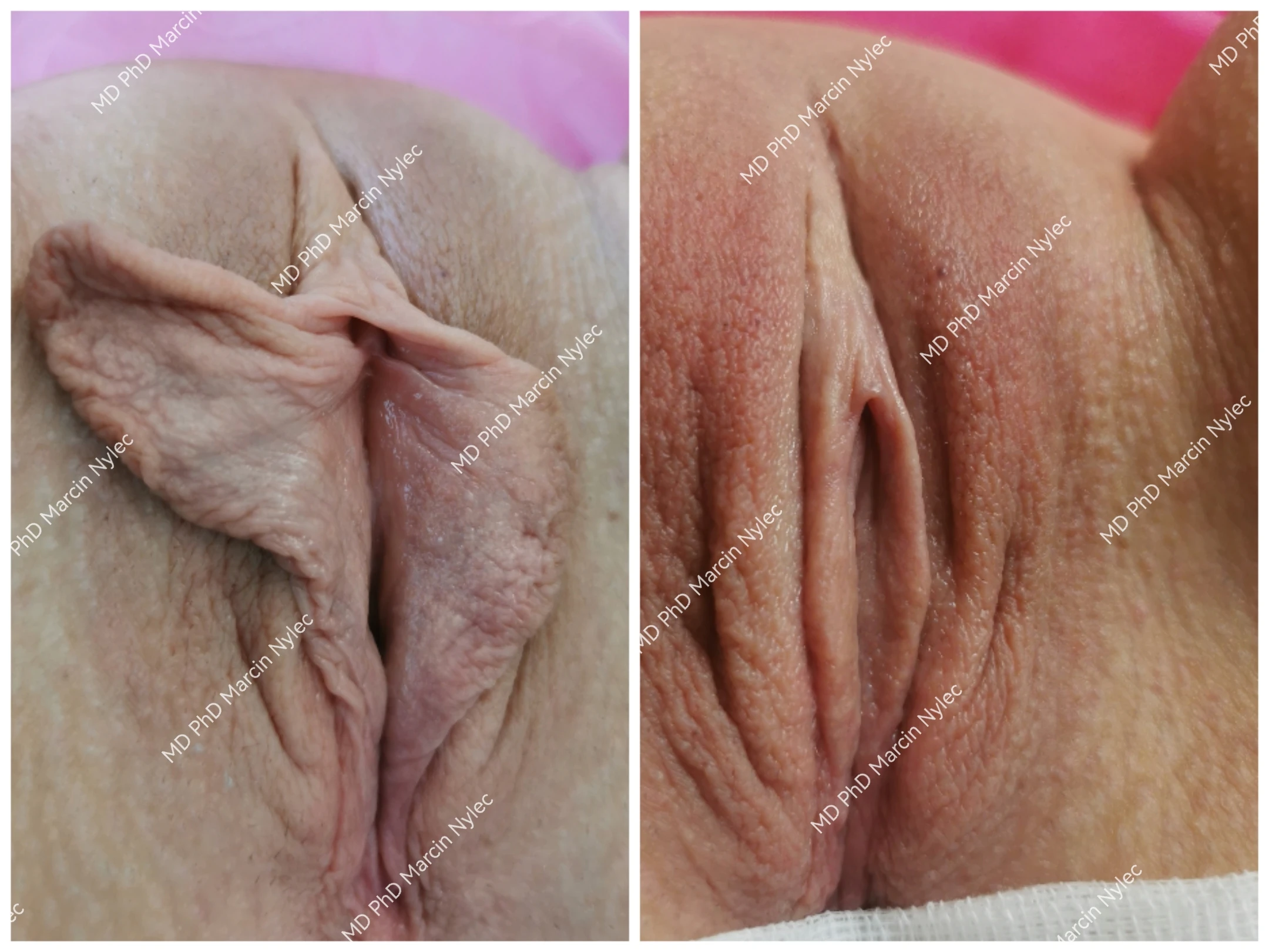 Kolaż przed i po plastyce warg sromowych mniejszych oraz napletka łechtaczki u 34-letniej pacjentki z Krakowa, poprawa symetrii i estetyki okolicy intymnej.