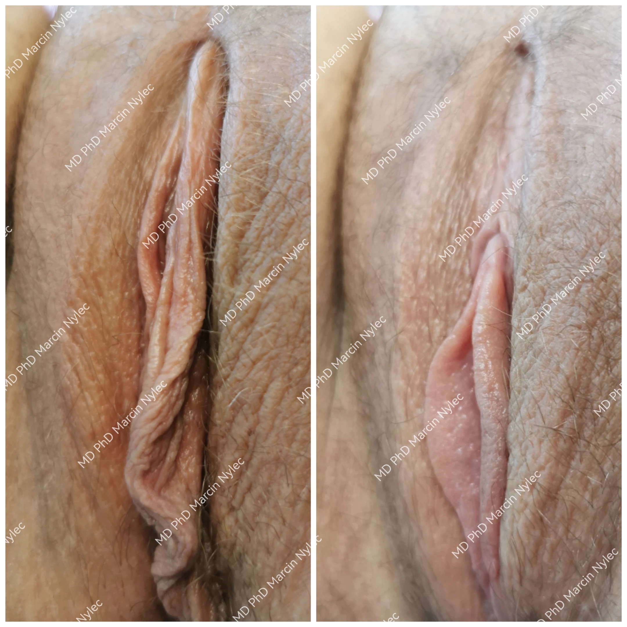 Por&oacute;wnanie przed i po labioplastyce metodą Dual Harmony u pacjentki 22 lata z Wrocławia, ten sam kadr w dw&oacute;ch wersjach, widoczna poprawa kształtu warg sromowych mniejszych.