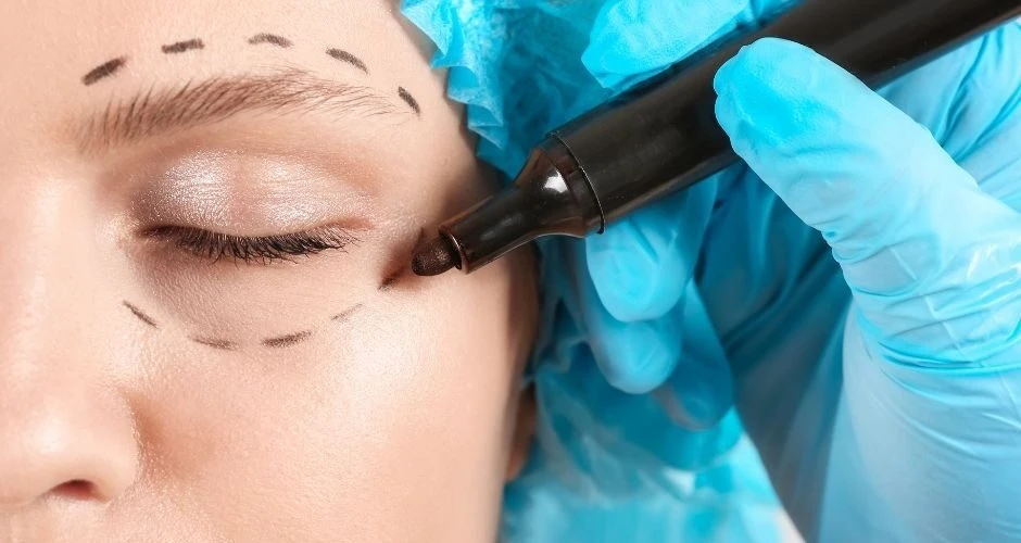 Plastyka powiek g&oacute;rnych Masterclinic