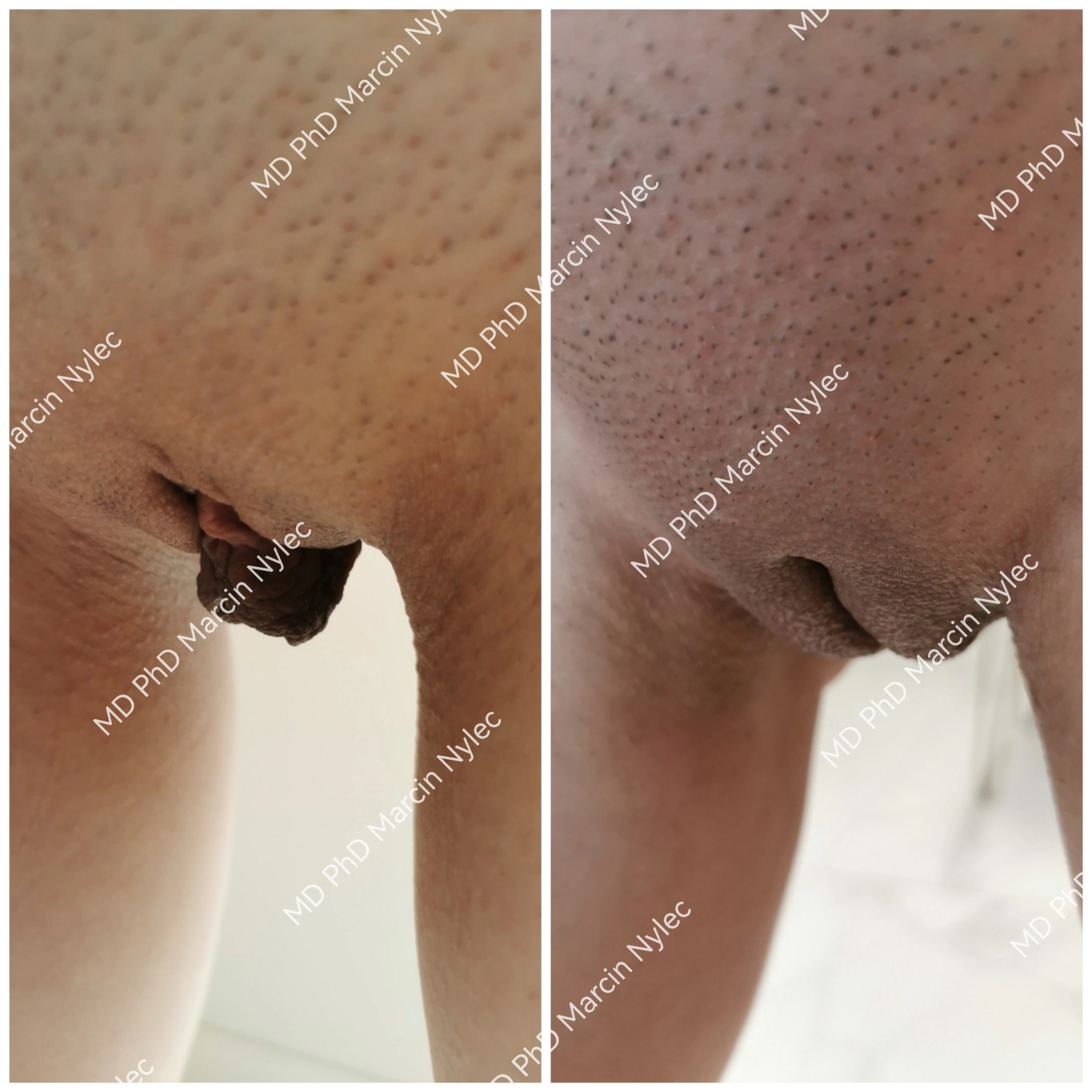 Kolaż zdjęć przed po - labioplastyka metodą Dual Harmony, pacjentka 39 lat, symetryczny i naturalny rezultat.