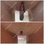 Labioplastyka przed i po Warszawa - przypadek 520, korekta asymetrii warg sromowych mniejszych