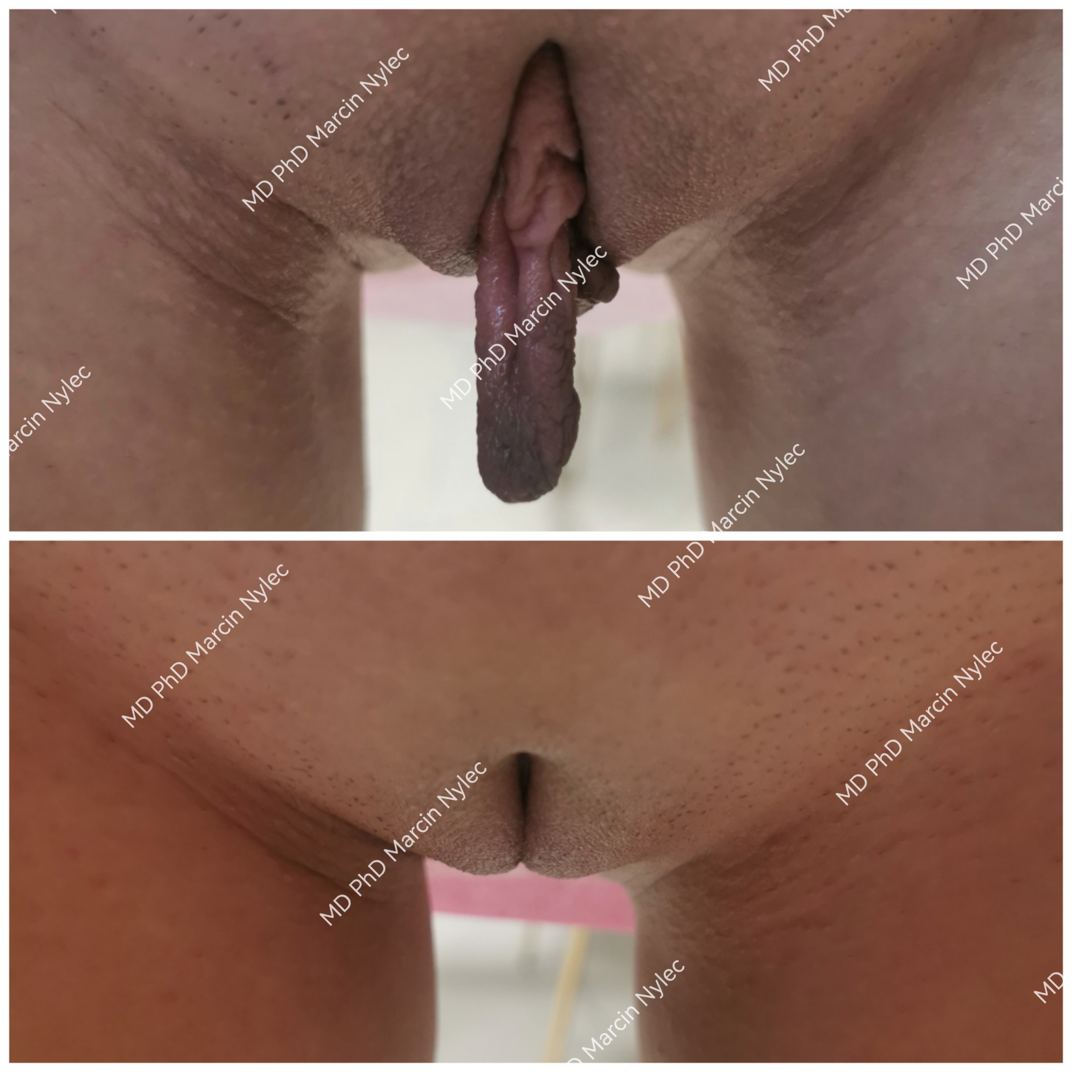 Labioplastyka przed i po Warszawa - przypadek 520, korekta asymetrii warg sromowych mniejszych