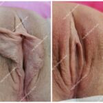 Labioplastyka Kraków - efekt przed i po u 34-letniej pacjentki po dwóch porodach