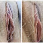 Labioplastyka przed i po - korekta asymetrii warg sromowych mniejszych, przypadek 620