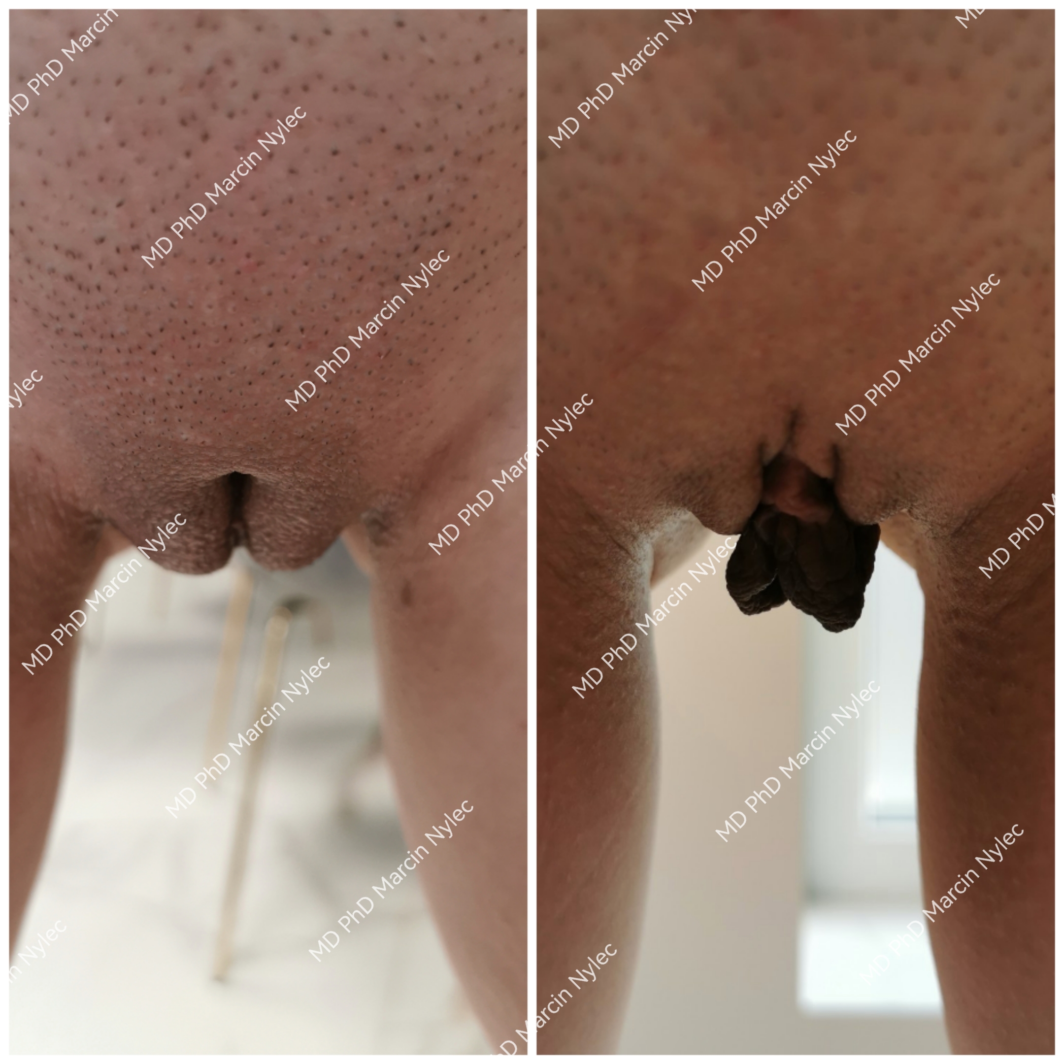 Labioplastyka przed i po - przypadek 651, korekta przerostu warg sromowych mniejszych